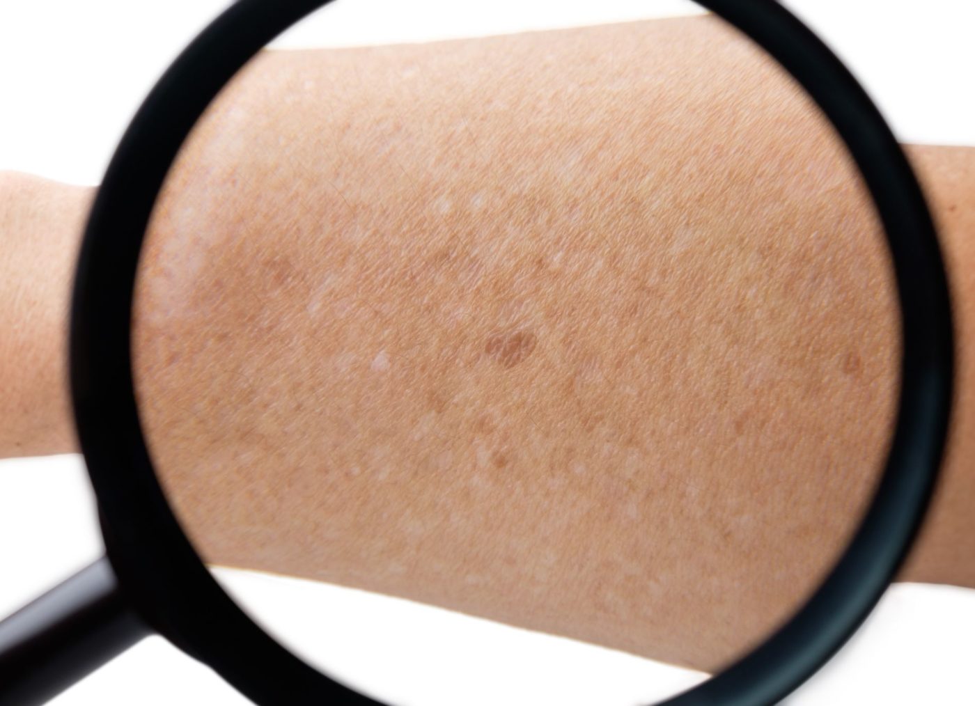 Magnifying glass on arm with Small white and brown spots on the skin